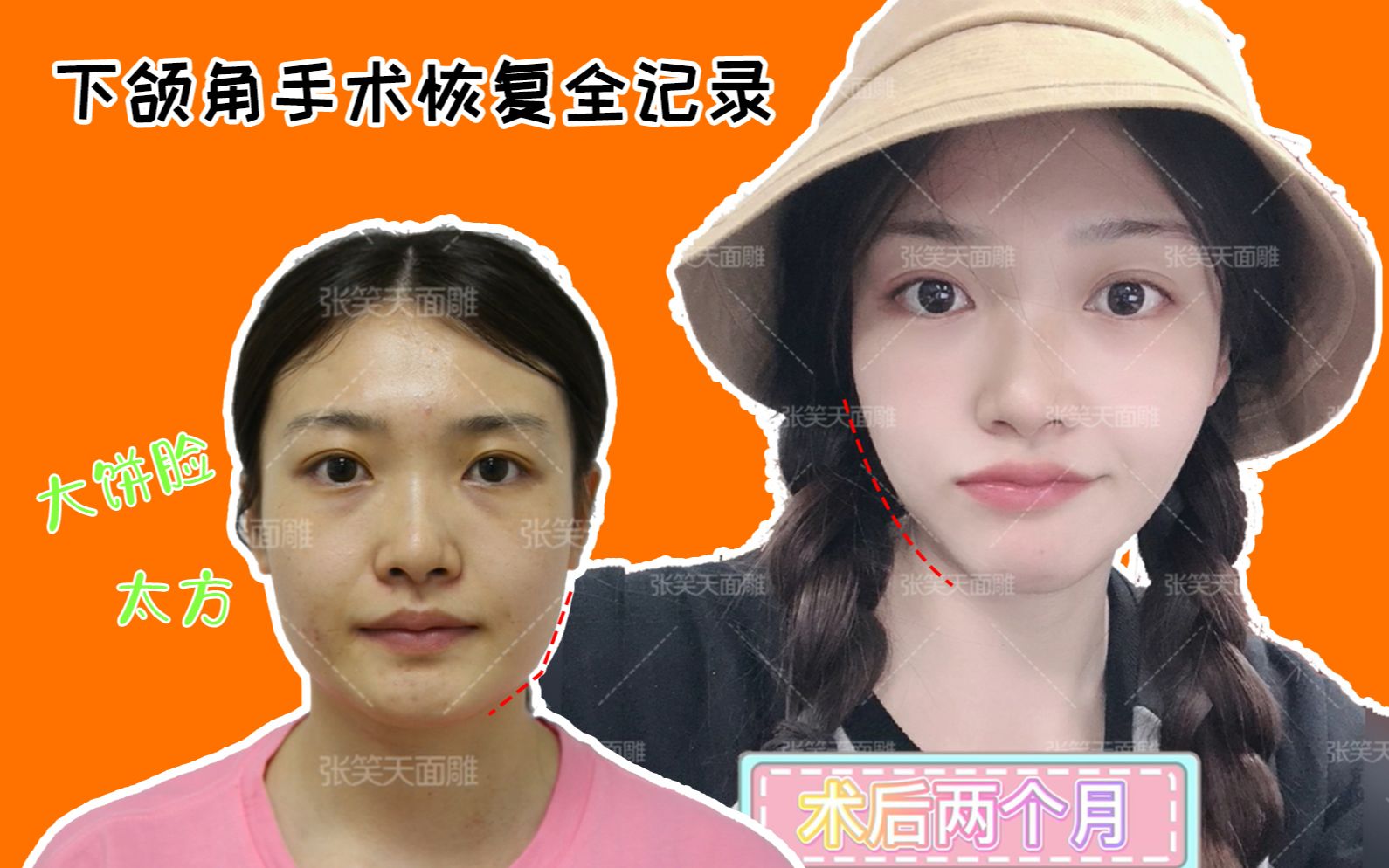 张笑天下颌角案例|下颌角截骨 去外板术后对比图,告别"土肥圆"