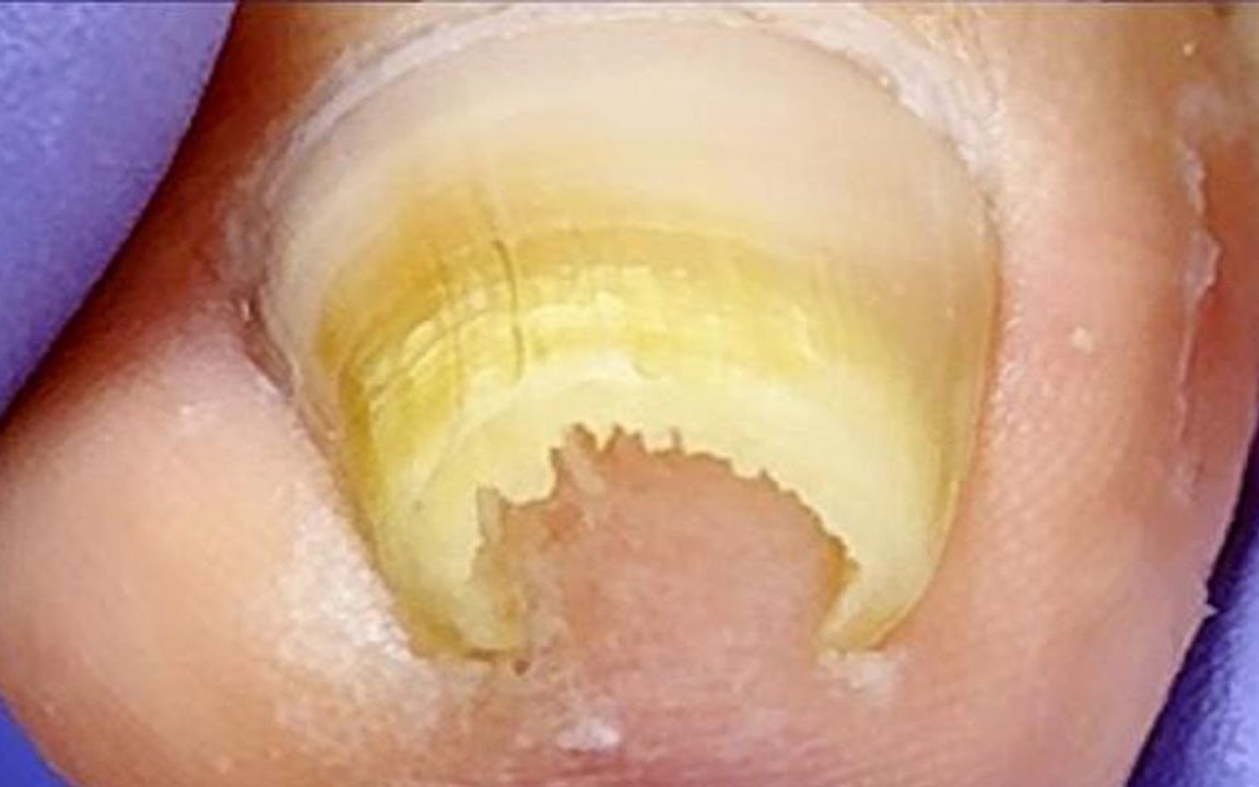 【内嵌甲】【甲沟炎】变形,卷曲的脚趾甲,恢复脚趾健康