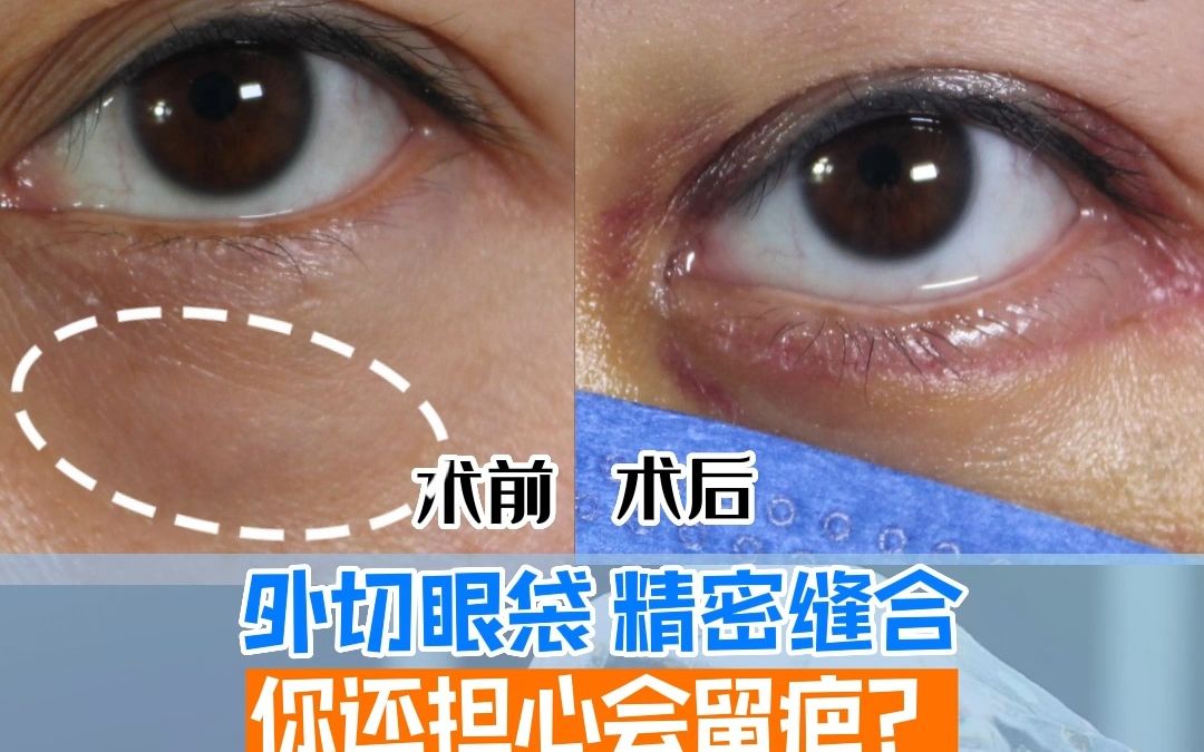 外切眼袋的精密缝合,你还担心留疤吗?