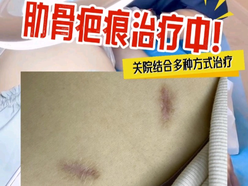 两条肋软骨隆鼻后留下的疤痕,一条针脚明显,增生锯齿状加色素沉淀,一