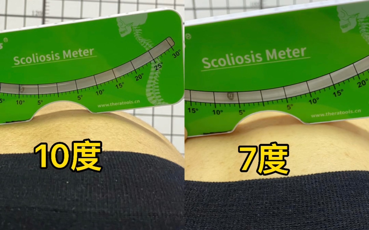 15岁侧弯女孩一次训练高低背减3度效果不错