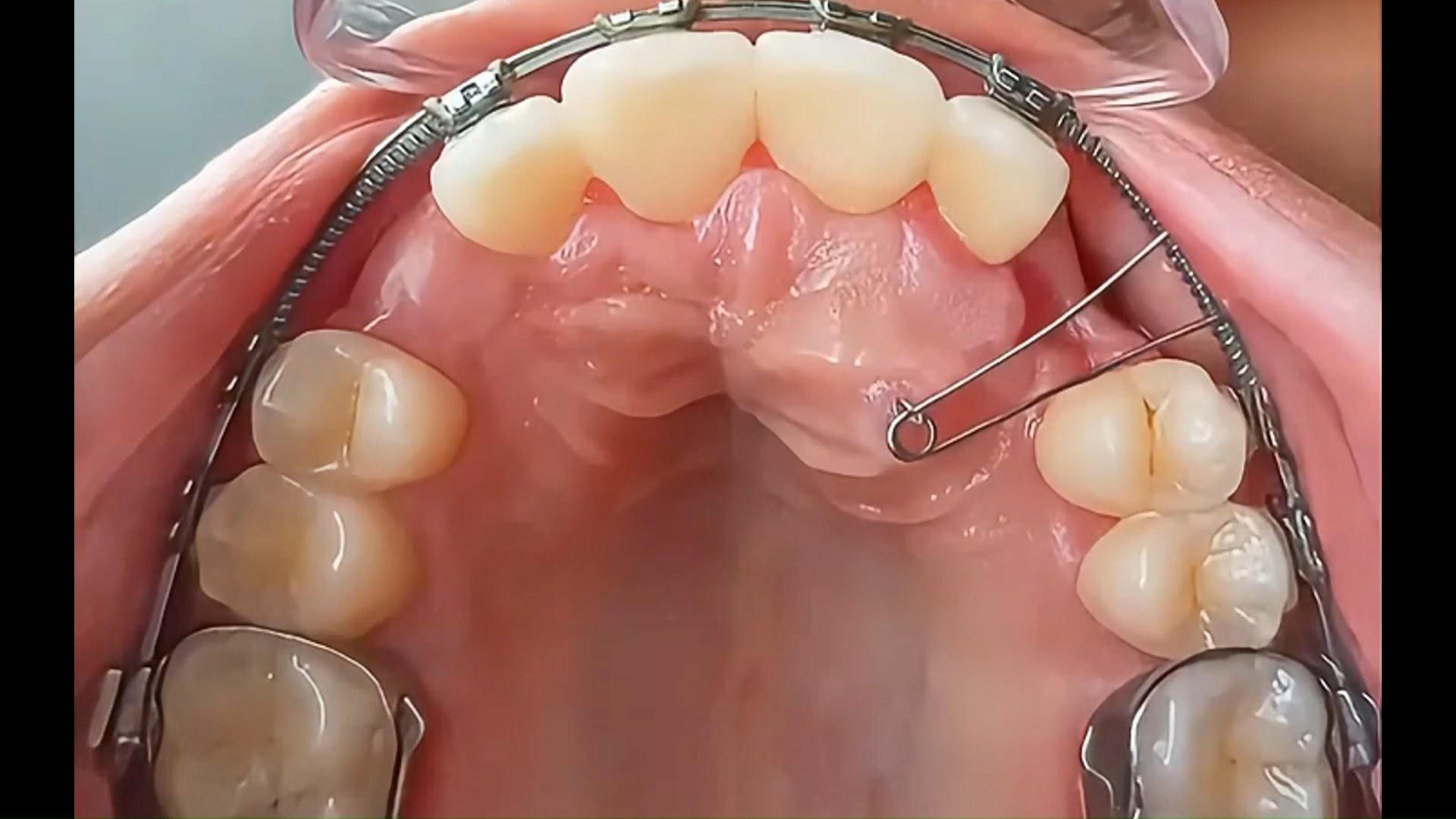 北京牙齿矫正:发现儿童埋伏牙,及时戴上牙套牵引矫正!