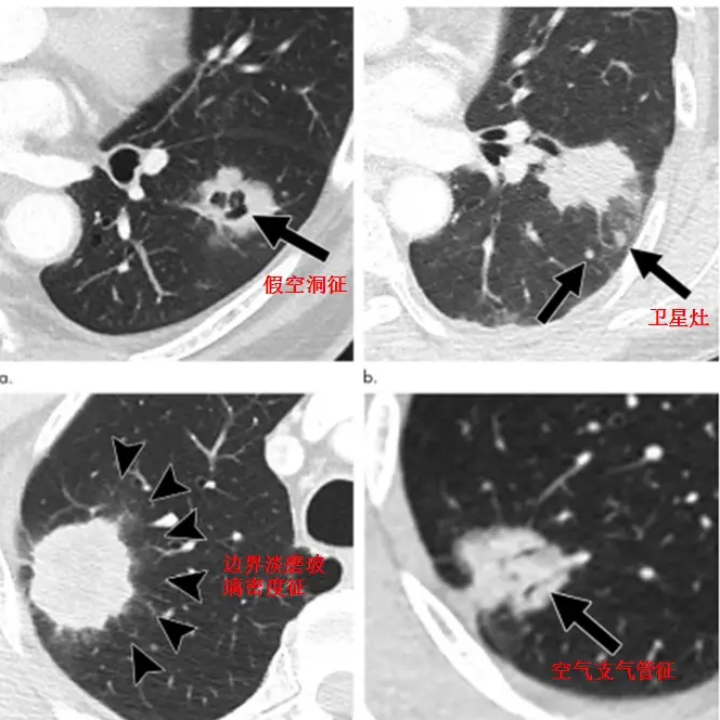 肺病变征象:假空洞征、卫星灶、空气支气管征哔哩哔哩bilibili