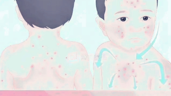水痘 四世同堂