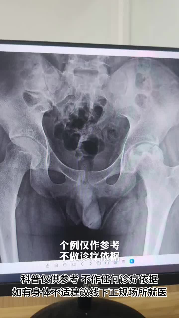 15岁小患者左侧股骨头坏死3期