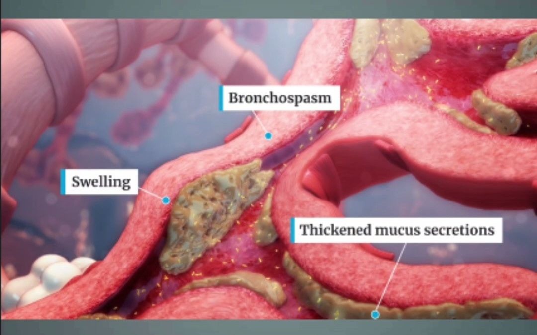 3D医学动画:严重哮喘的机体反应哔哩哔哩bilibili