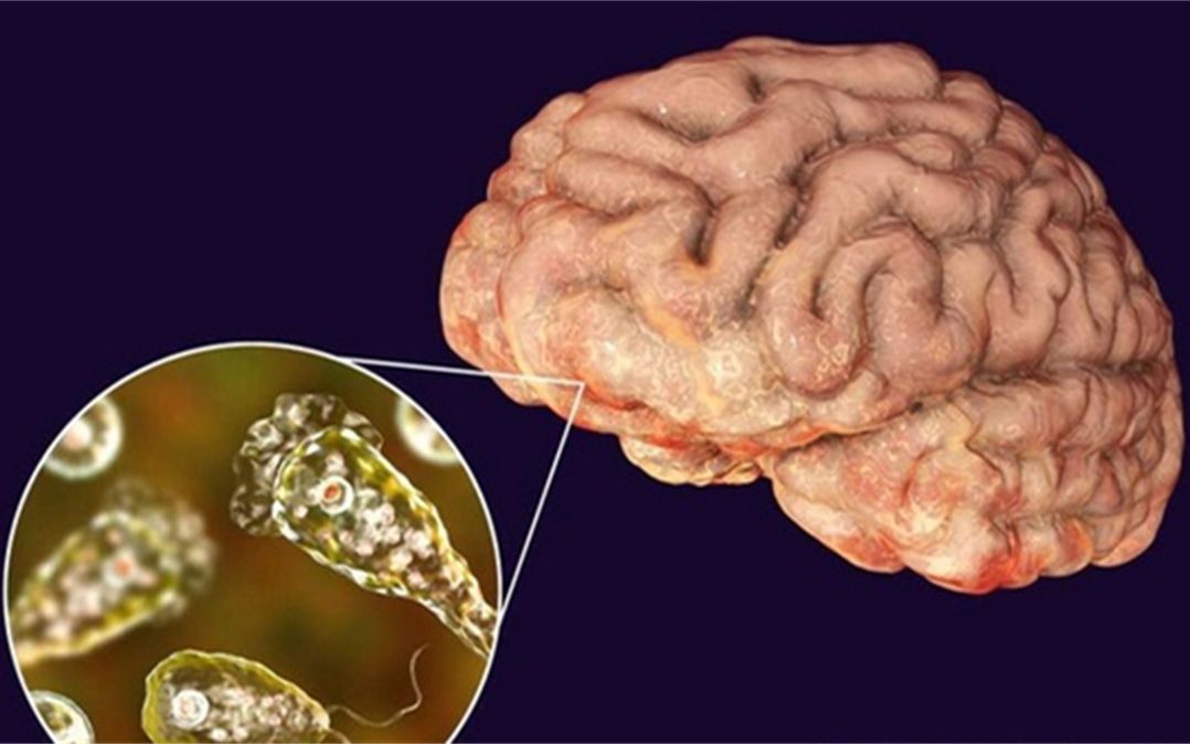 危险美国游客在游泳后感染了食脑变形虫正在治疗