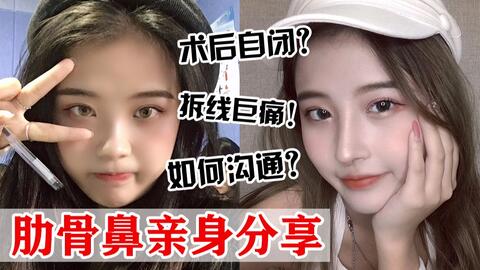 我做了韩国神颜高允真同款鼻子 术后痛到想去世的整容全过程记录 耳软骨隆鼻改善嘴凸 哔哩哔哩 Bilibili