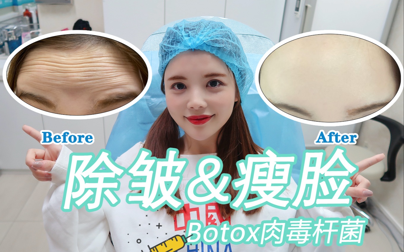 活動作品醫美vlog除皺針i瘦臉針i瘦肩針i瘦腿針i除狐臭原來都是botox