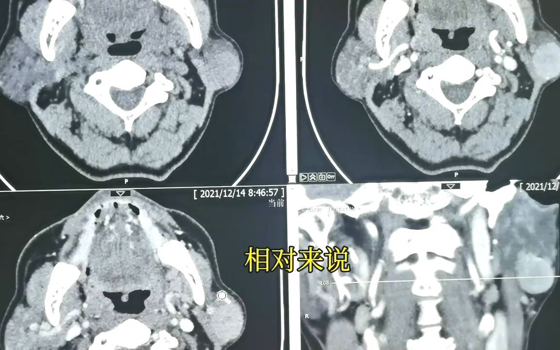 【典型病例】腮腺肿瘤鉴别,多形性腺瘤,腺淋巴瘤,基底细胞瘤哔哩哔哩bilibili