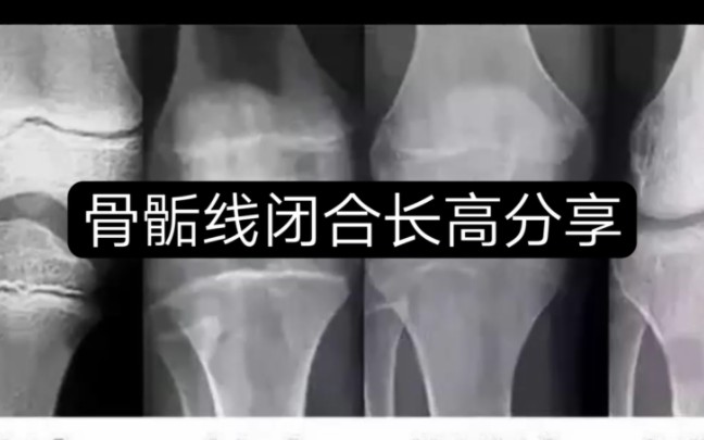 骨骺线闭合长高分享
