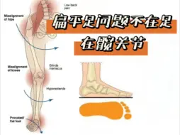 Tải video: 扁平足的问题通过处理足部，理论上是没错的，但不是直接便捷的方式，处理髋关节能快速改善扁平足，减少肌肉代偿和关节代偿。