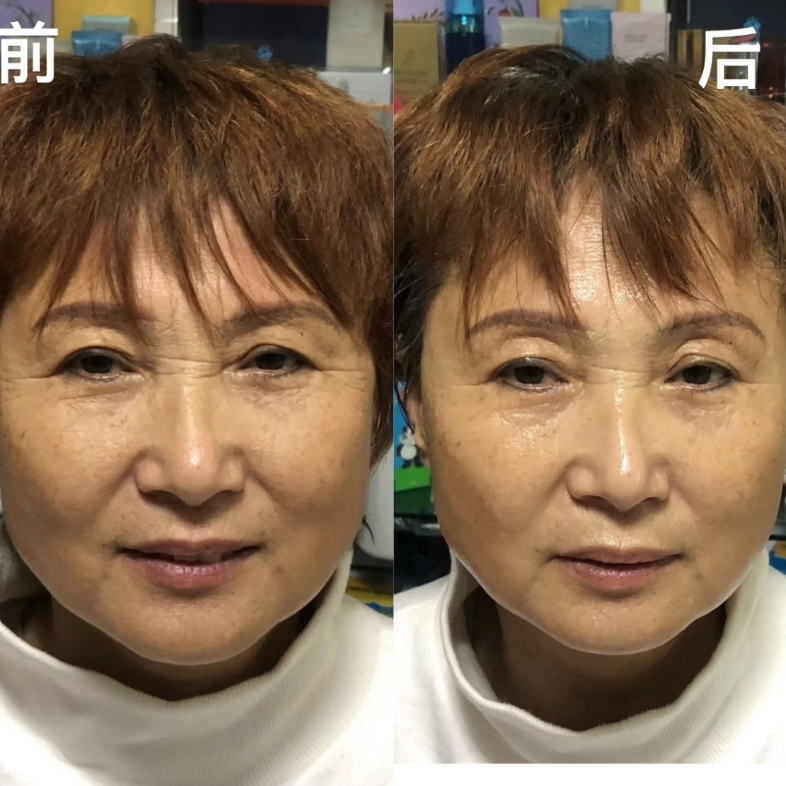 原相机一次雅姿护理前后对比