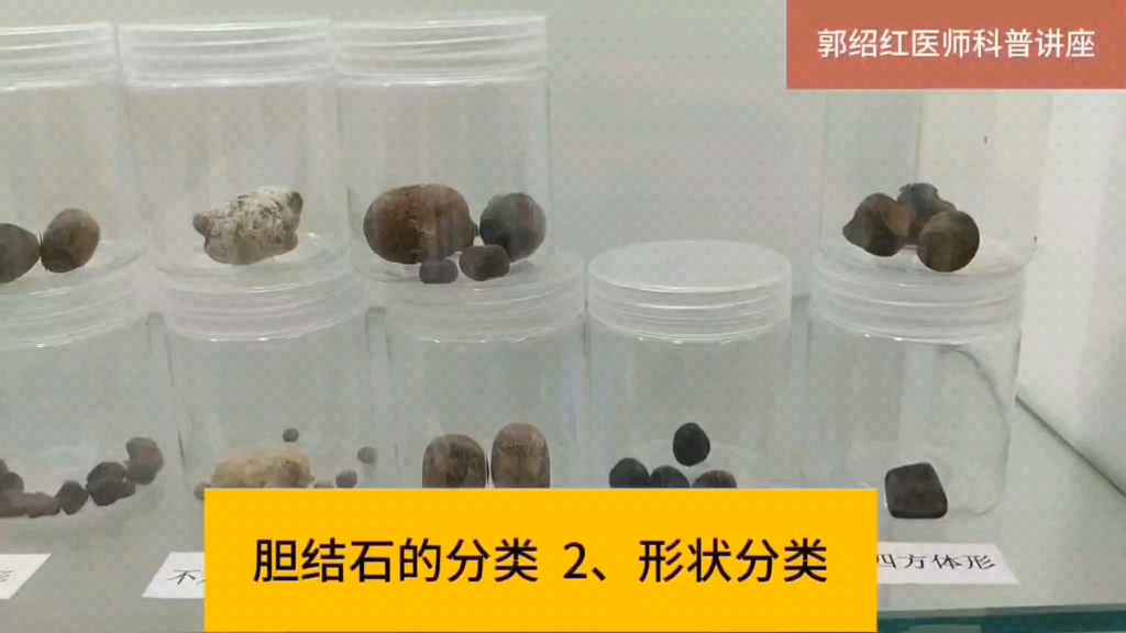 胆结石的分类 2,形状分类
