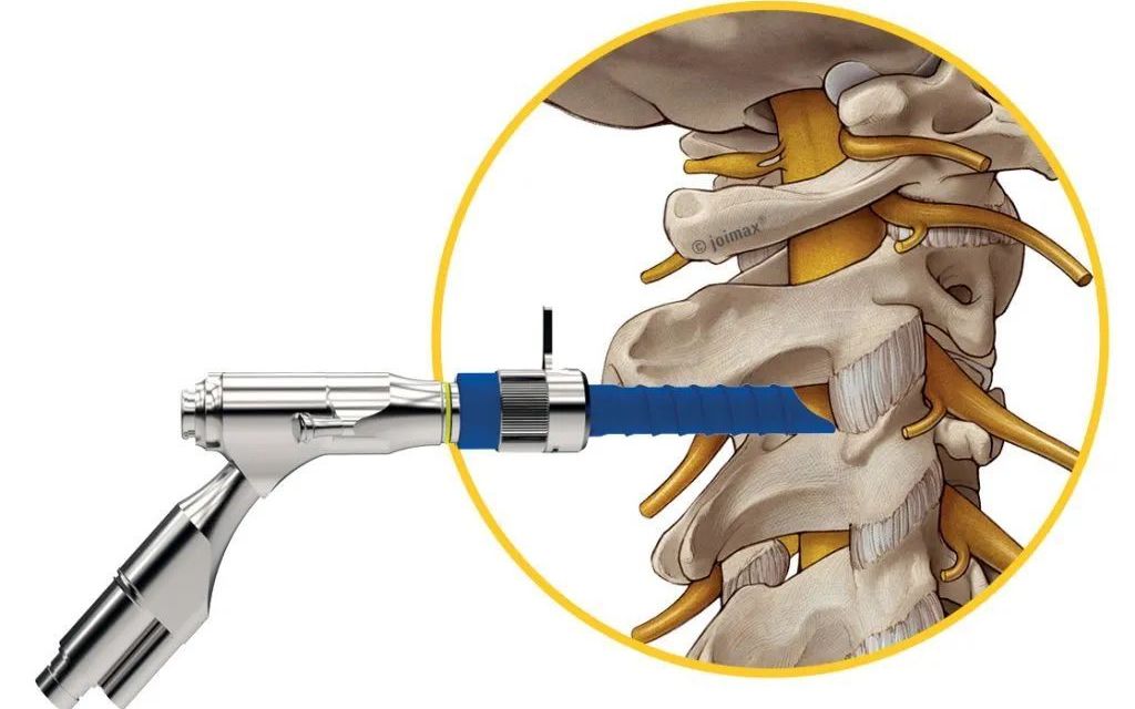 【基础知识&Coka】经皮椎板间入路全脊柱内镜下手术(percutaneous endoscopic interlaminar discectomy,PEID)哔哩哔哩bilibili