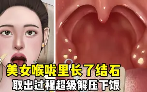 Download Video: 美女喉咙里长了扁桃体结石，导致了她经常出现口臭，取出全程超级解压下饭