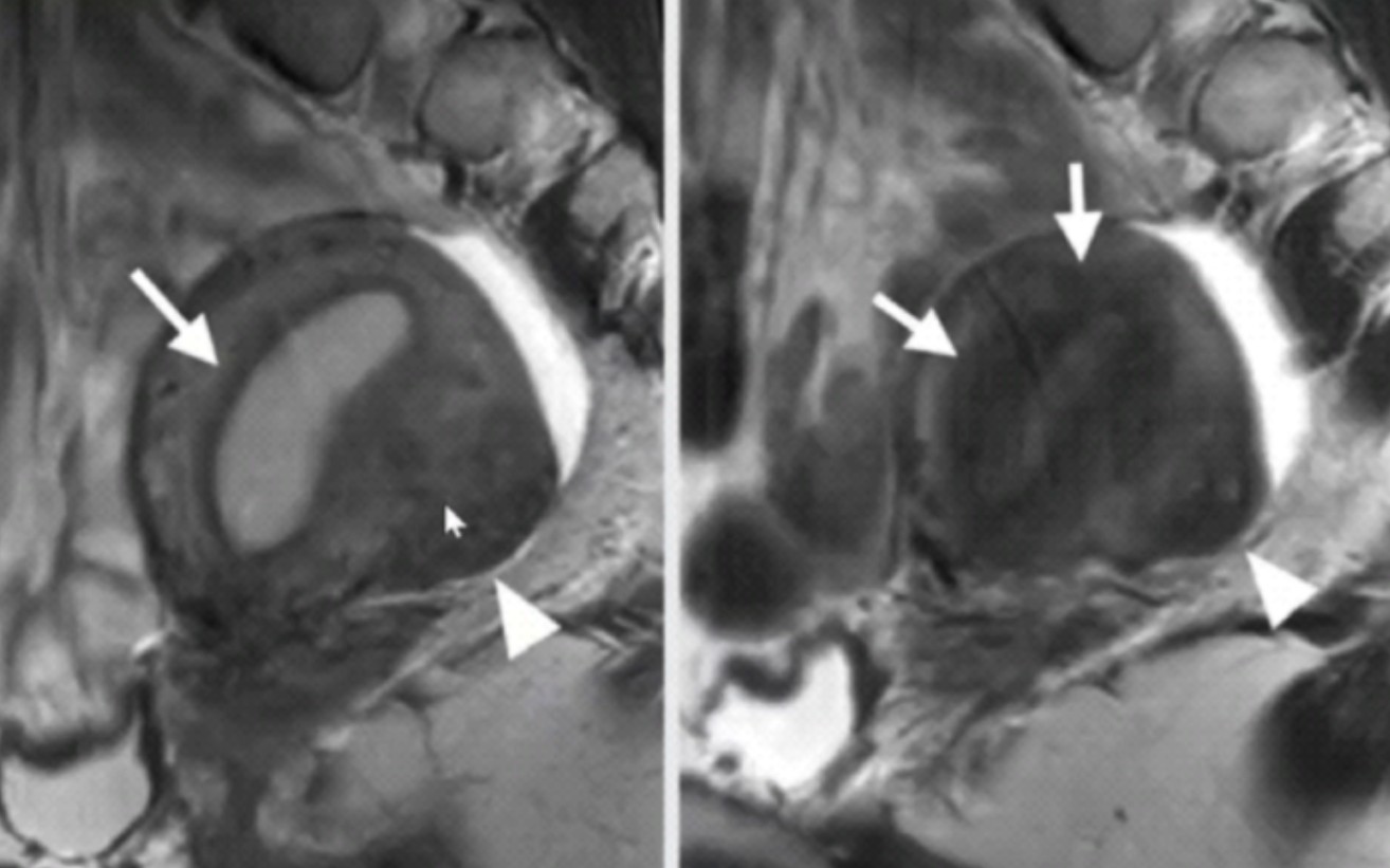 不同生理状态下子宫等生殖器官的MR表现.哔哩哔哩bilibili