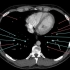 肺动脉CTA肺静脉CTV断层解剖-CT-影像解剖系列
