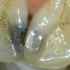 牙齿有龋坏，牙医补牙会用到哪些东西？