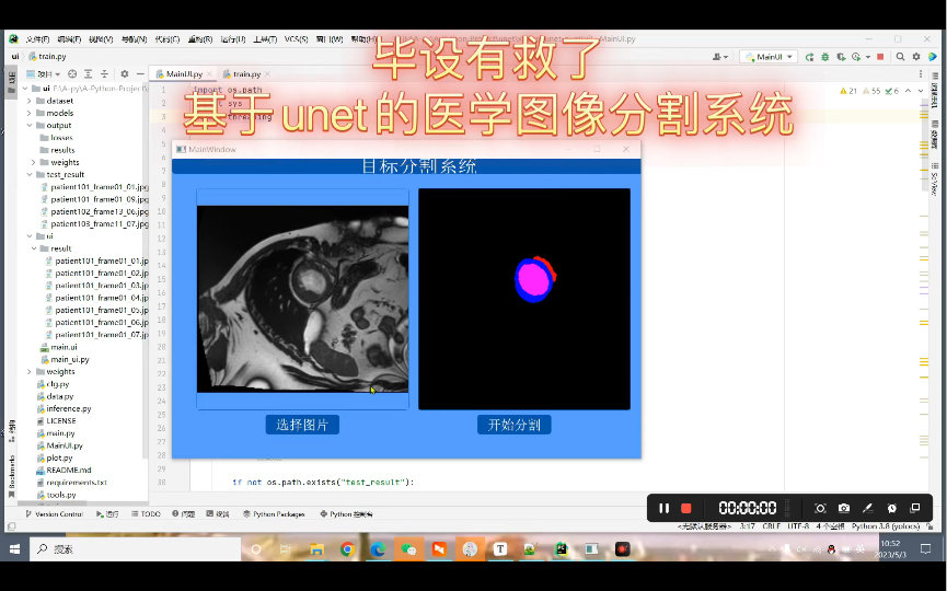 毕设基于unet的医学图像分割系统unet的心脏辅助分割系统哔哩哔哩bilibili