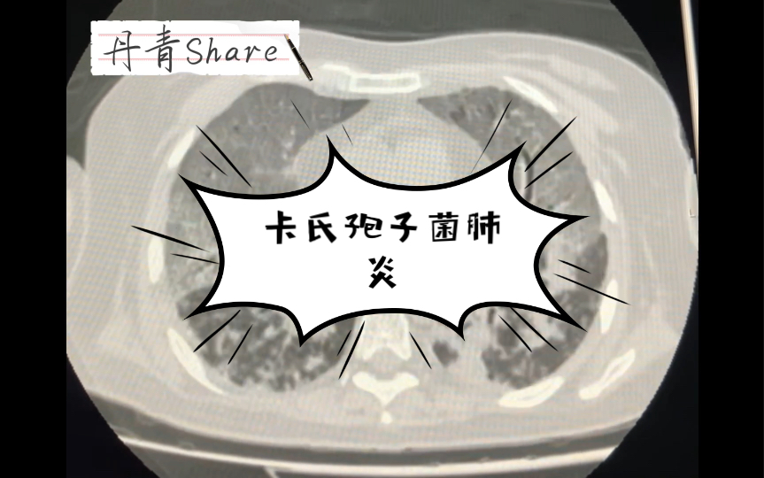 活动作品卡氏孢子菌肺炎