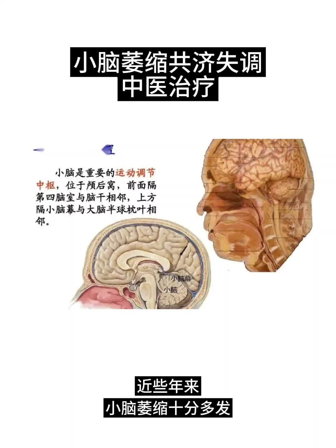 小脑萎缩怎么调理最好图片