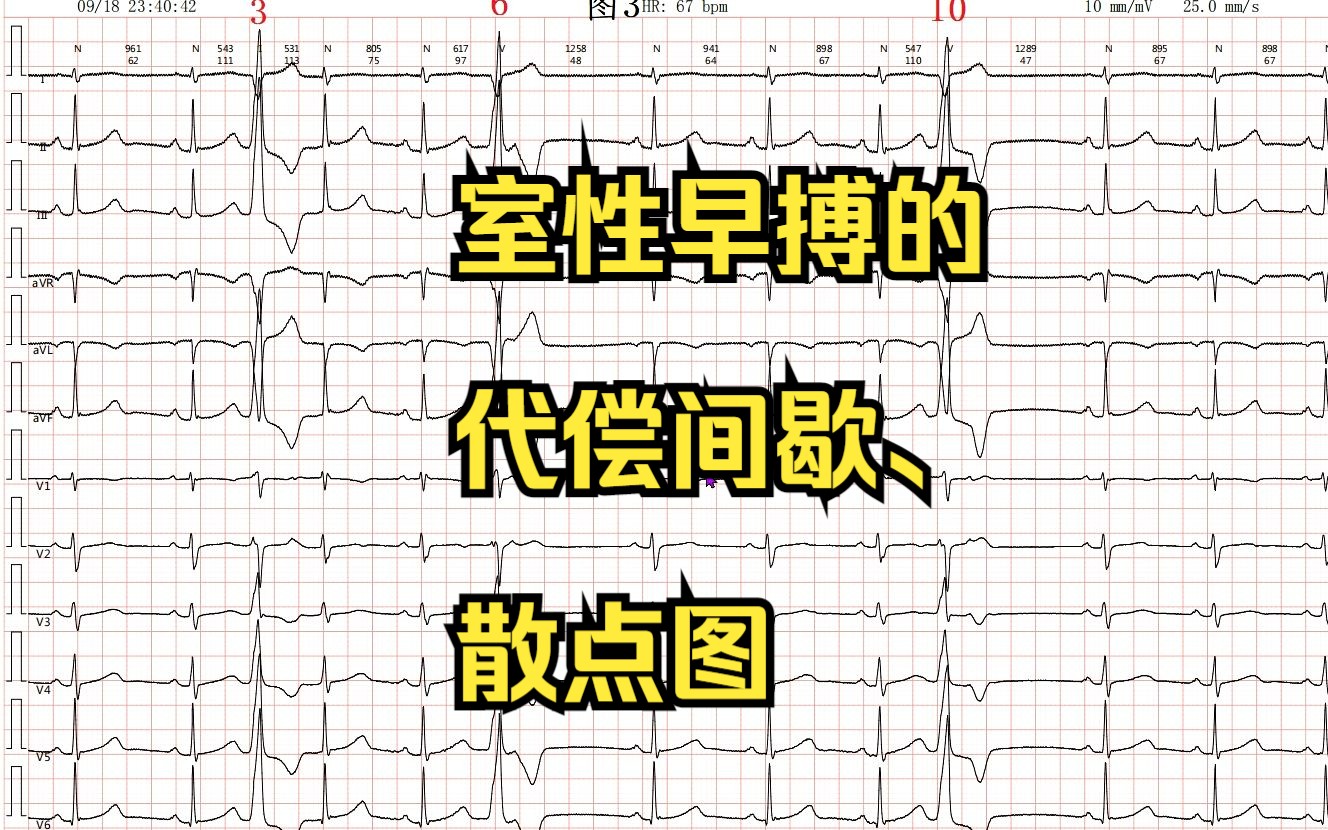 室性早搏的代偿间歇,散点图