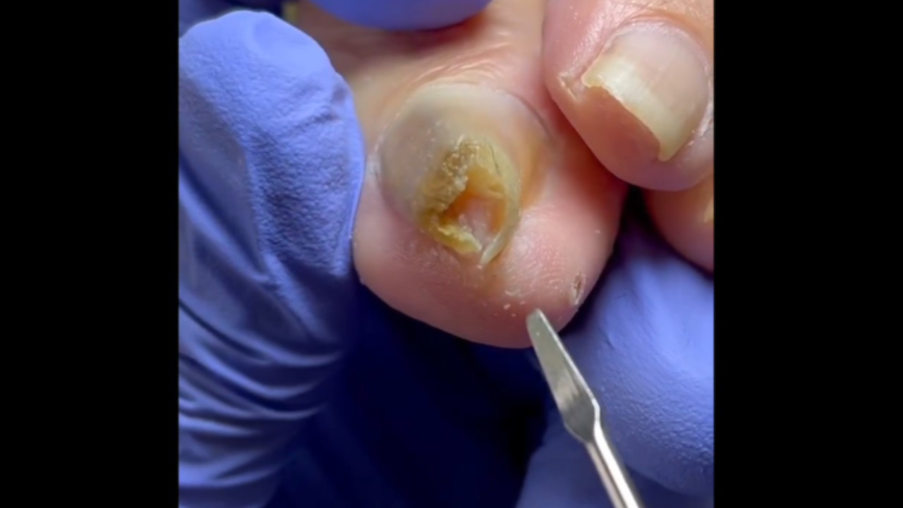 内卷嵌甲完美闭合