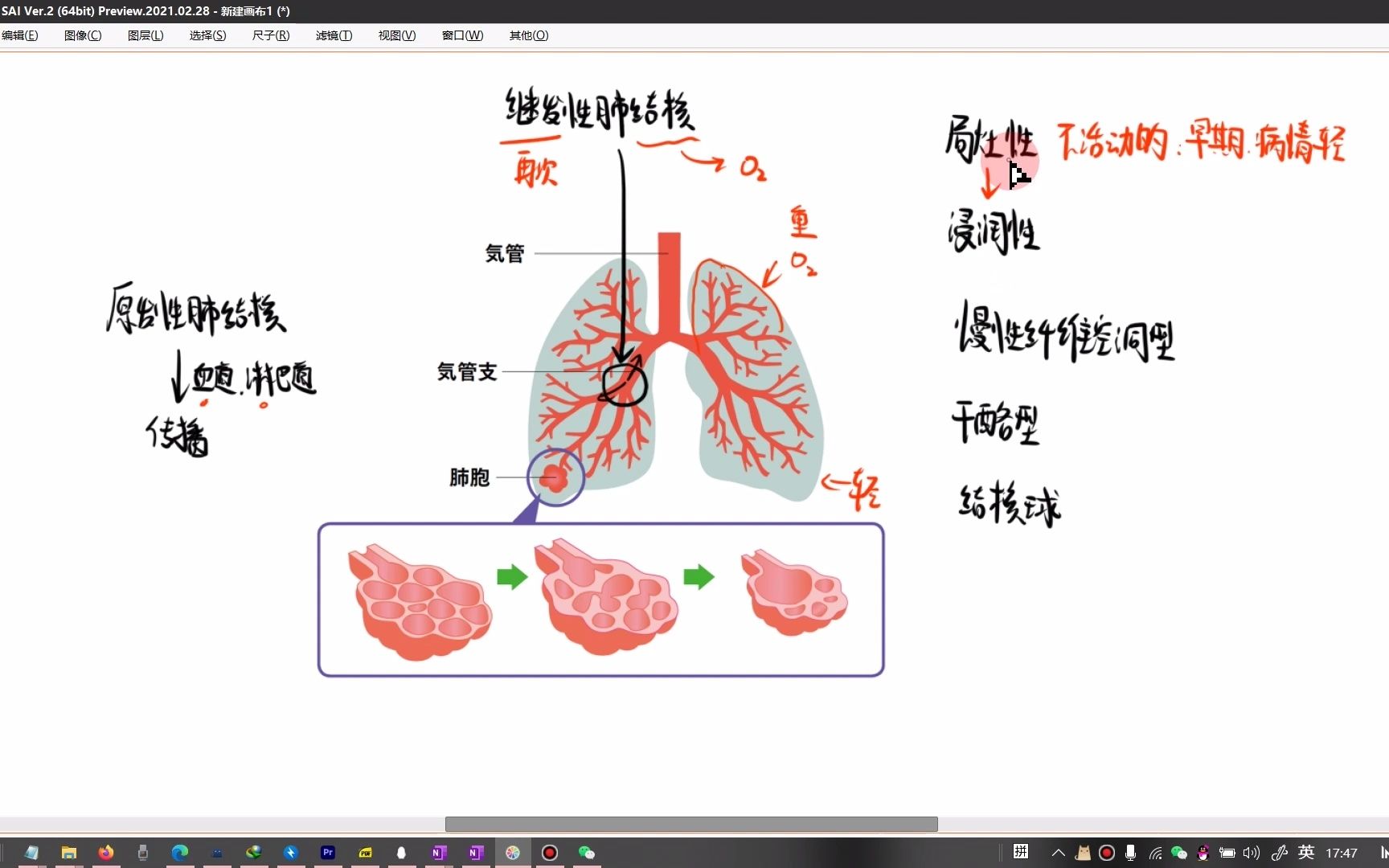 继发性肺结核(局限性肺结核、浸润性肺结核、干酪性肺炎......)哔哩哔哩bilibili