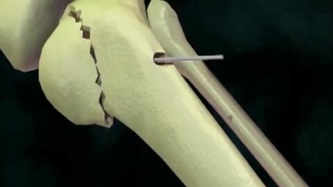 3d视频 先进的医学技术 胫骨骨折微创手术动画视频 哔哩哔哩
