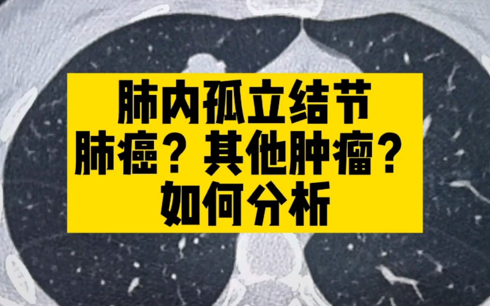 【疑难病例】发现肺内孤立结节,肺癌?其他良性肿瘤?需要考虑哪些肿瘤,如何简单鉴别.医学生,医学影像,放射科医生哔哩哔哩bilibili