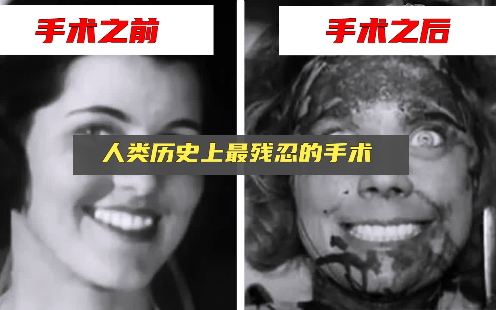 [图]人类历史上最可怕的“脑叶切除手术”，残忍程度已超出人类的理性