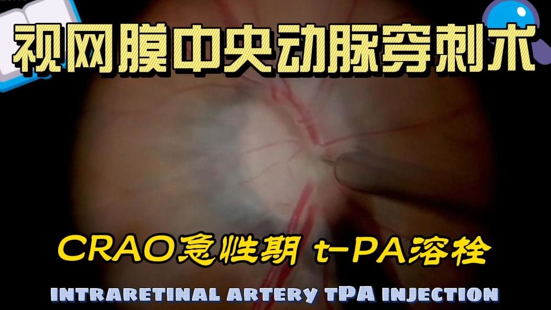 【中英】【CRAO: 视网膜中央动脉穿刺注射tPA溶栓术】How to do intraretinal artery tPA injection哔哩哔哩bilibili