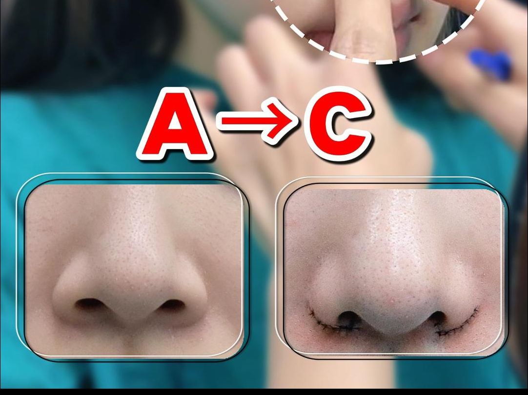 鼻翼肥大内外切即刻