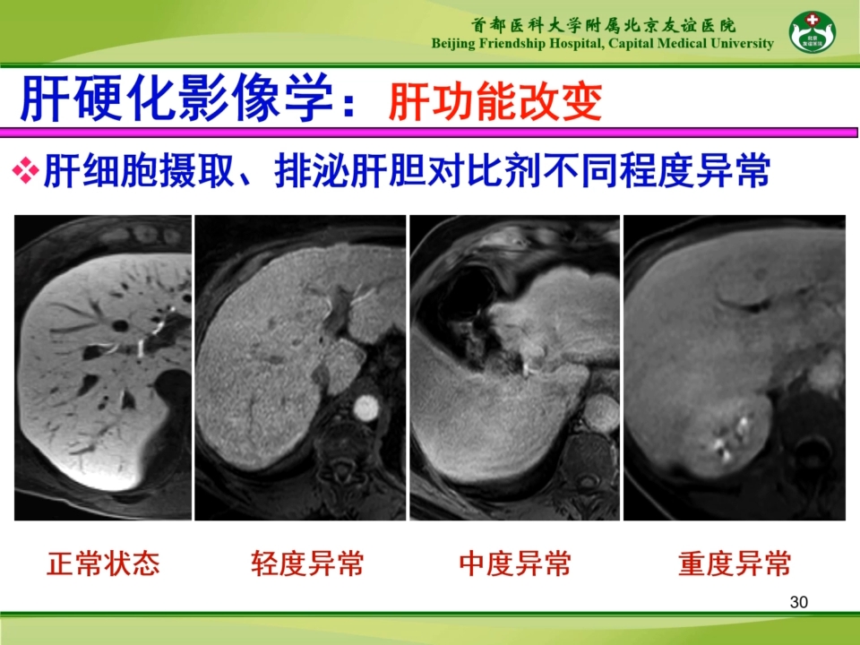 杨正汉:肝硬化影像学诊断(全套肝脏基本征象与影像表现共8集,见评论区)哔哩哔哩bilibili