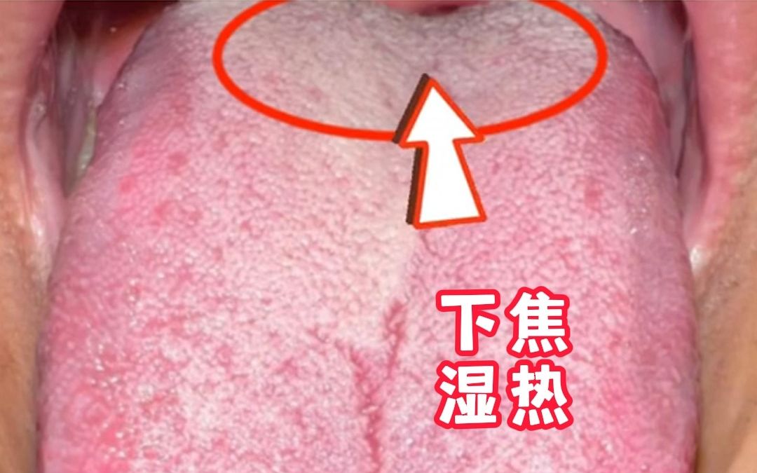 舌诊分析:一旦出现这种舌根苔厚的舌象,补肾要放到最后一步!