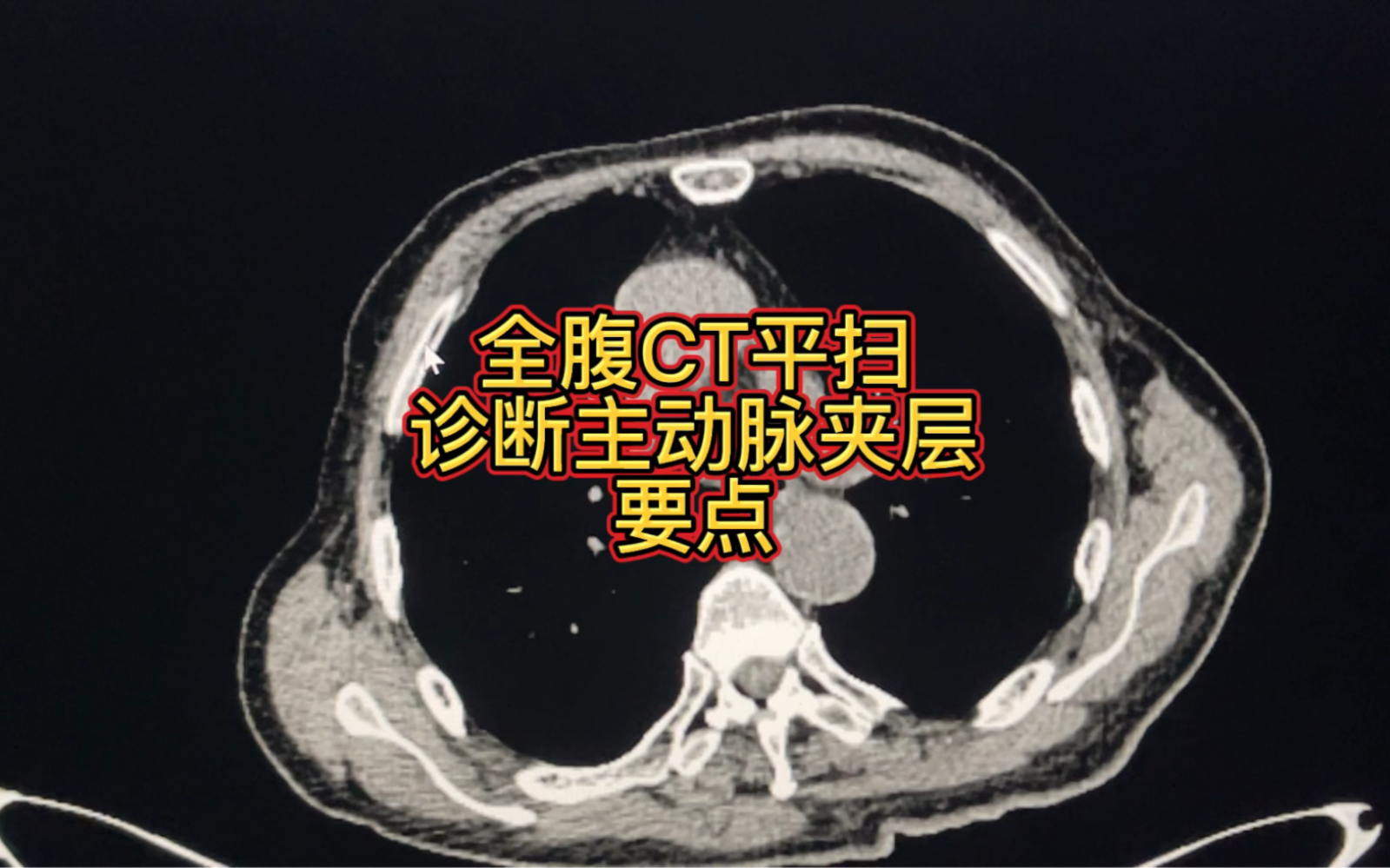 [图]实例解读全腹部CT平扫诊断主动脉夹层的要点