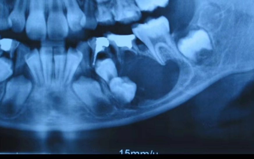 [图]地狱级口腔病变 全麻手术 几万的账单 磨刀霍霍