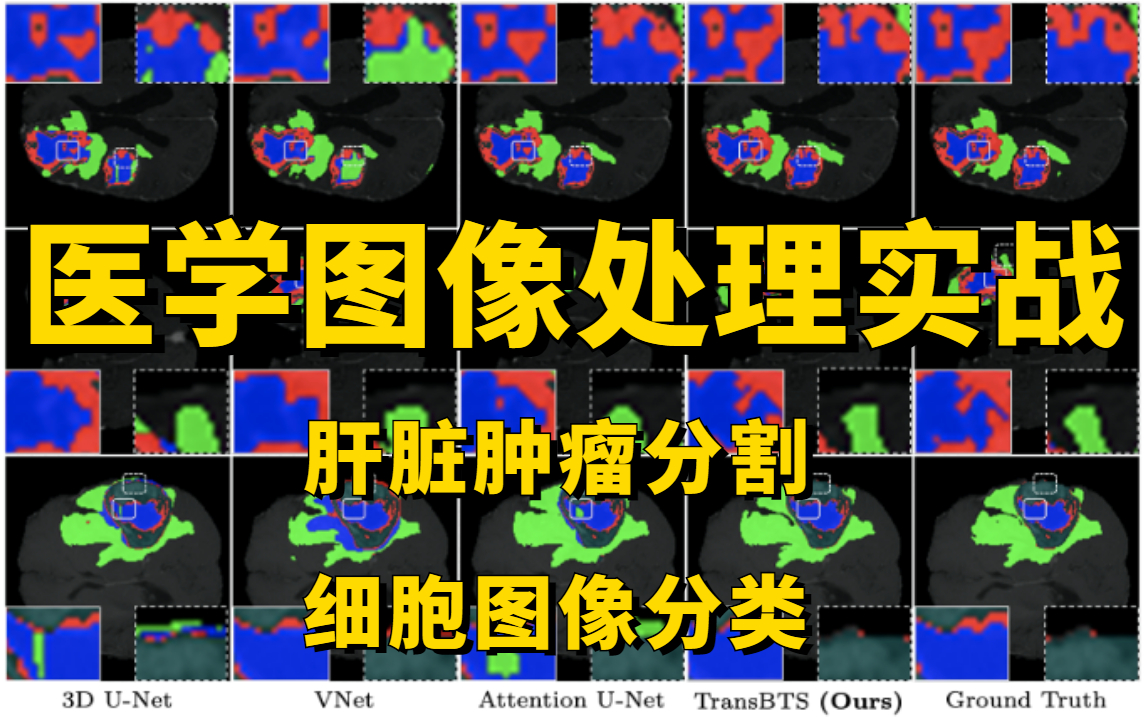 面向深度学习的医学图像处理实战:计算机博士精讲肝脏肿瘤分割及医学细胞分类实战,UNet/VNet/Resnet全详解!学完就能写进简历!哔哩哔哩bilibili