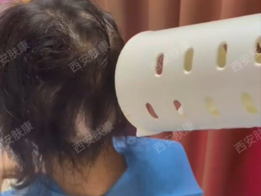 脱发治疗中