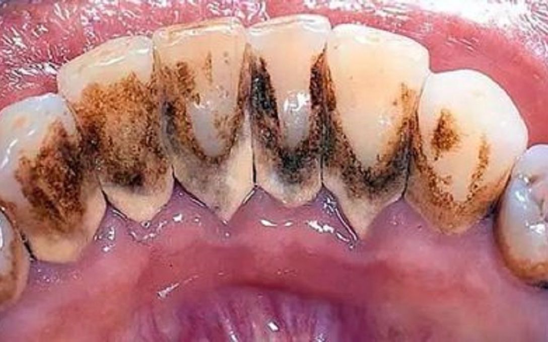 多年烟渍牙竟被1招解决!真后悔没早点用!成本低效果好!