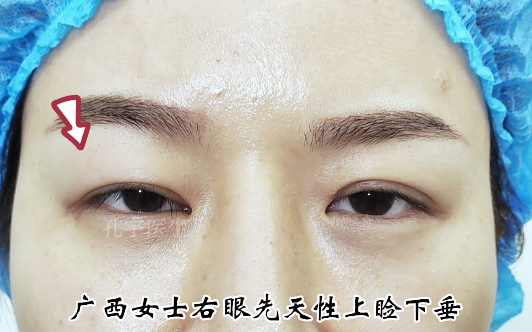 广西女士右眼先天性上睑下垂,15岁时做过一次矫正 改善不明显,右眼上