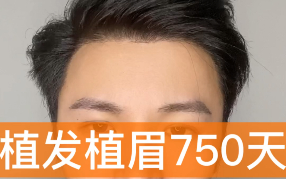 雍禾植发植眉(雍和植发种植眉毛)