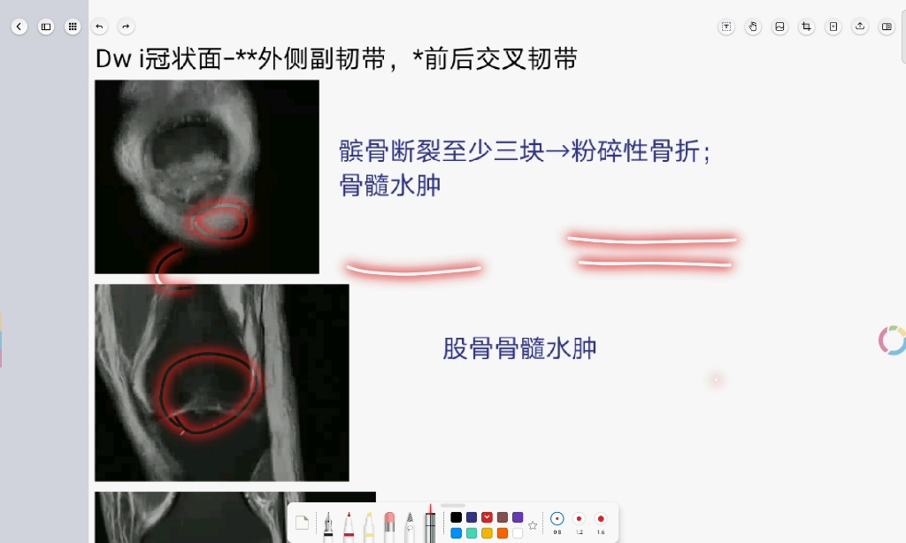 影像读片复盘 膝关节韧带损伤MRI哔哩哔哩bilibili