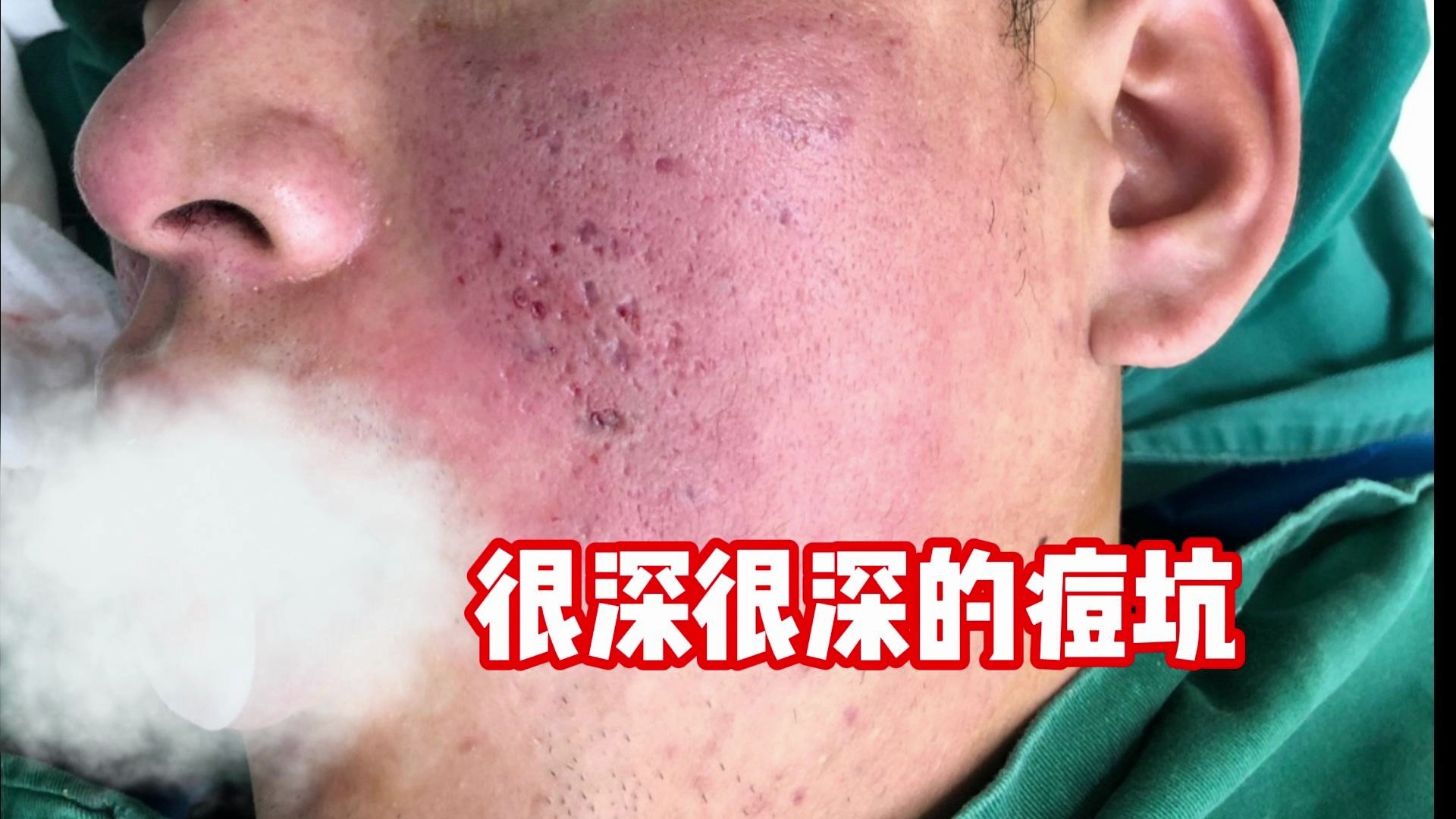 很深很深的痘坑,环钻+填充,术前术后的对比很明显哔哩哔哩bilibili