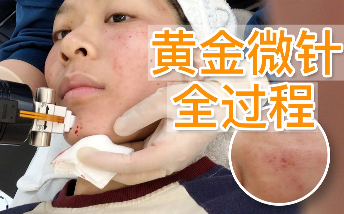 6800元一次的黄金微针到底香不香?黄金微针全过程丨VLOG哔哩哔哩bilibili