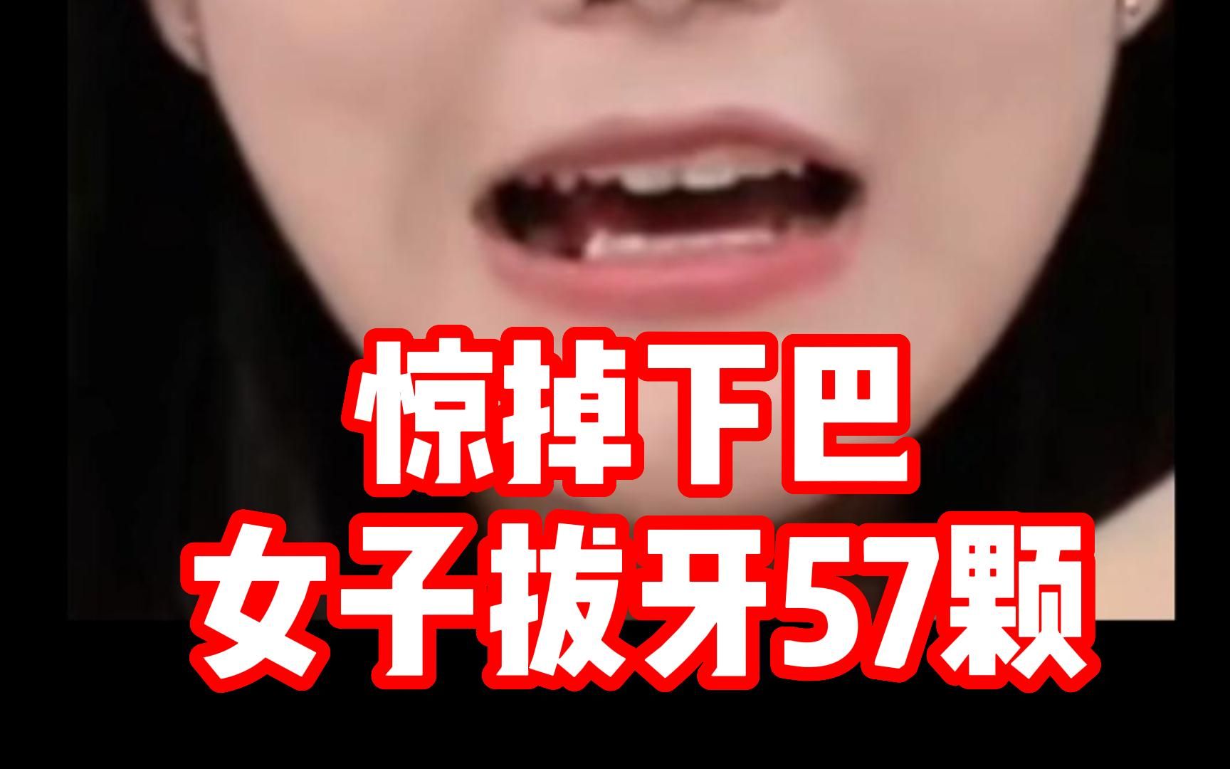 23岁女生患牙瘤拔掉57颗牙 网友:人体活化石啊活化石!哔哩哔哩bilibili