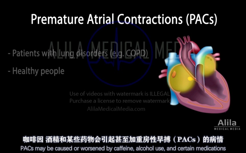 【Alila Medical Media 】15.房性期前收缩(房性早搏)哔哩哔哩bilibili