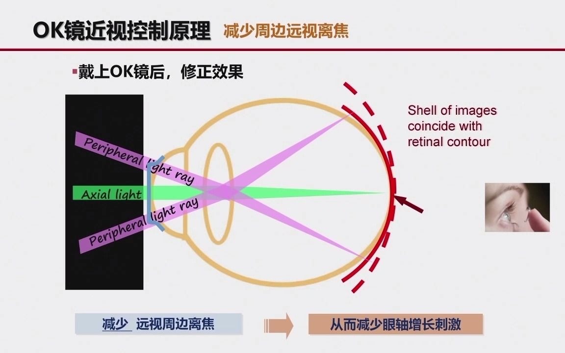 OK镜近视控制原理是什么?哔哩哔哩bilibili