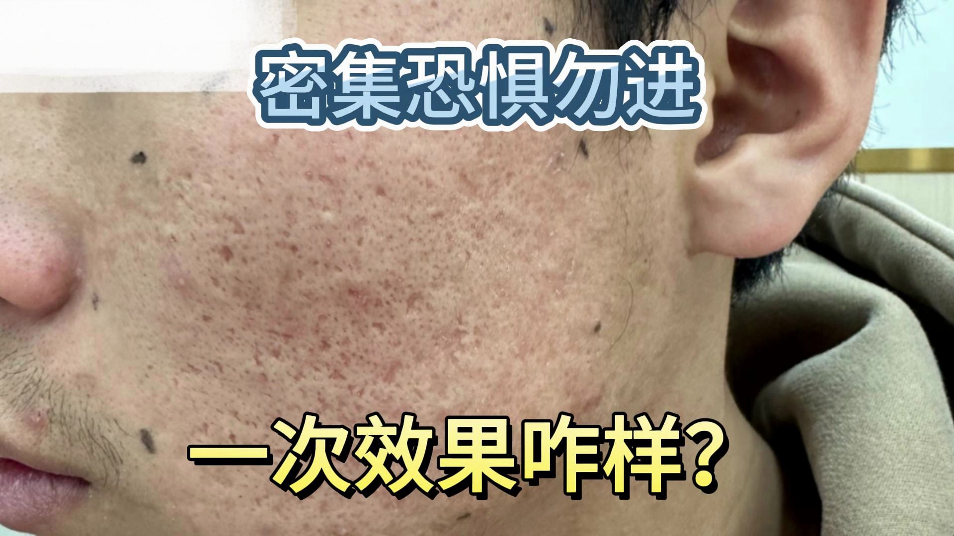 密集恐惧症犯了,这种一次治疗效果咋样?直接看前后对比!哔哩哔哩bilibili